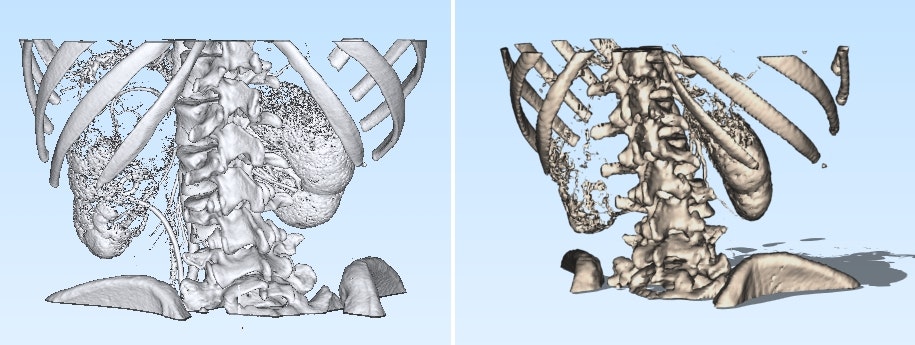dicomtostl - DICOM2STL, 의료 3D 모델 생성기, DICOMTOSTL 변환기 미디어 4