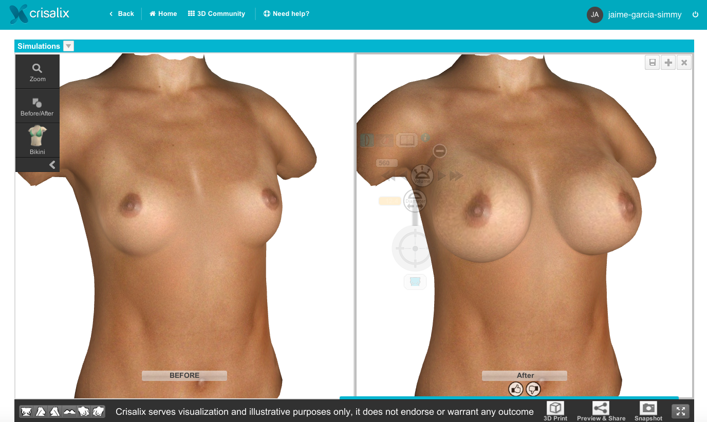 Crisalix gallery image