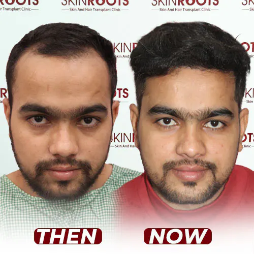 hair transplant 