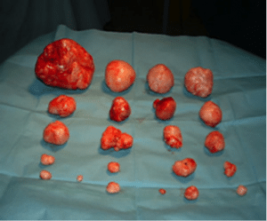 End Fibroids In 4 Months media 1