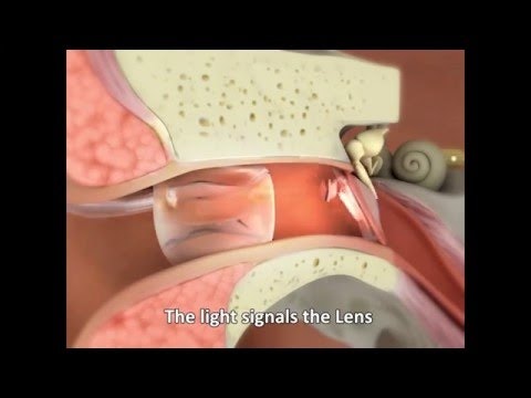 Earlens