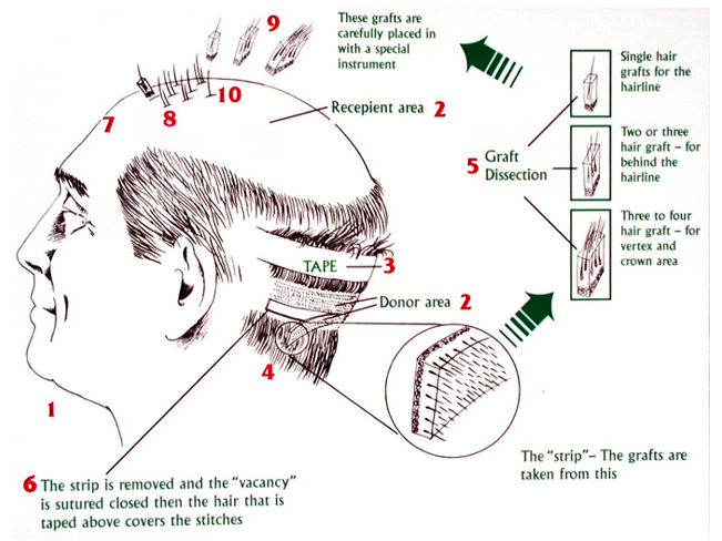 Trasplante de cabello