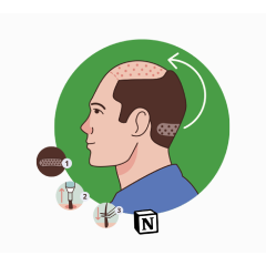 Processus et conseils de greffe de cheveux