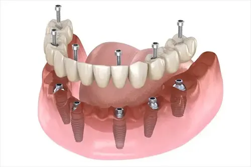 Dental Implants gallery image
