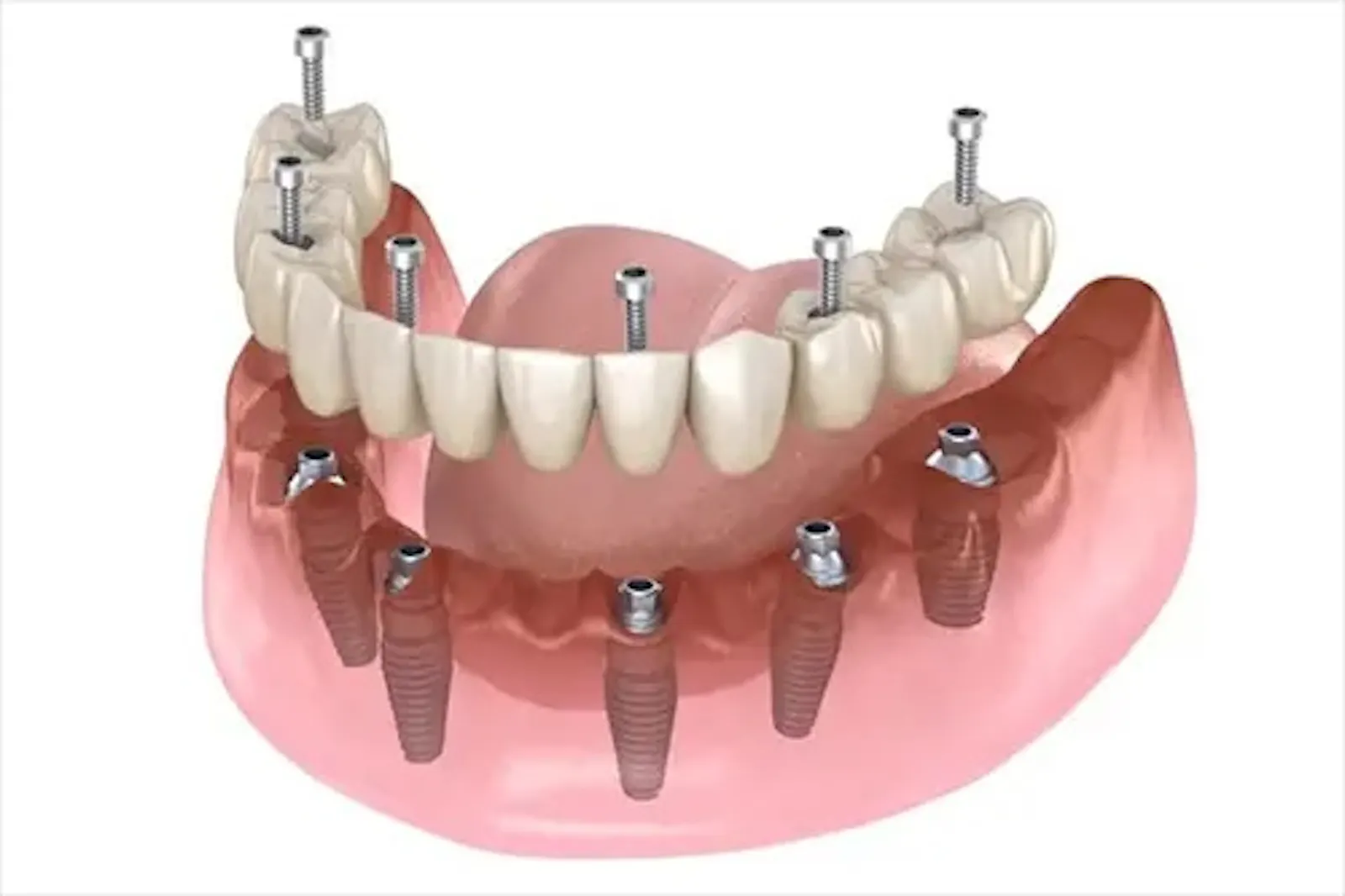 Dental Implants screenshot 1