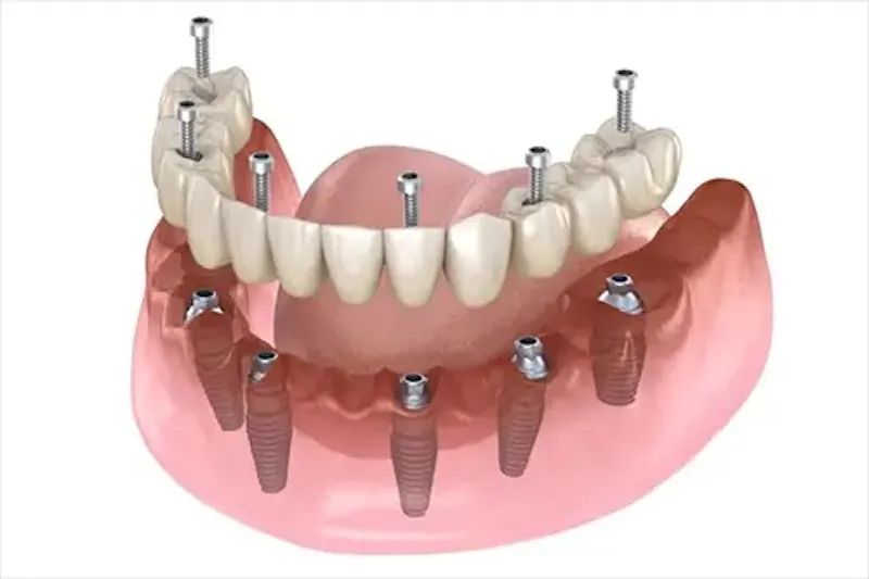 Dental Implants screenshot 1