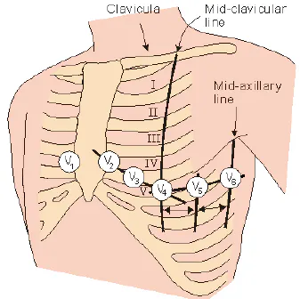 12 Lead ECG Placement: The Complete
