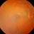 Eye Diabetic Retinopathy