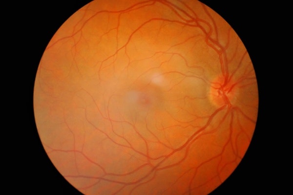 Retinopatia diabética ocular