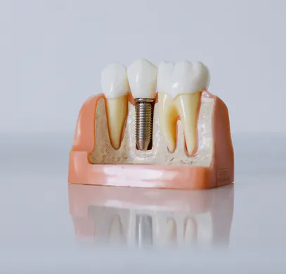 Dental Implants in Vijayawada のプロダクトバナー