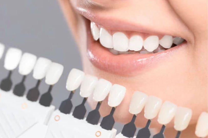 Onyx Smile Teeth Whitening Kit