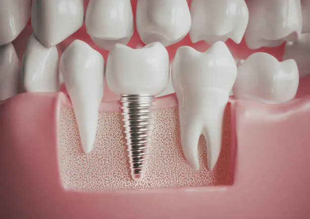 Best Dental Implant Clinic Malviya Nagar gallery image