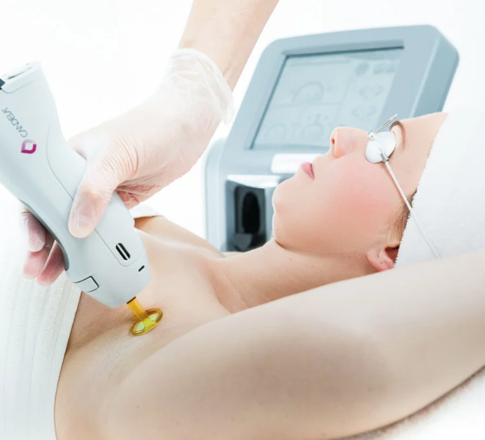 Media Pusat Laser Chic - Perubatan Spa Montreal 3