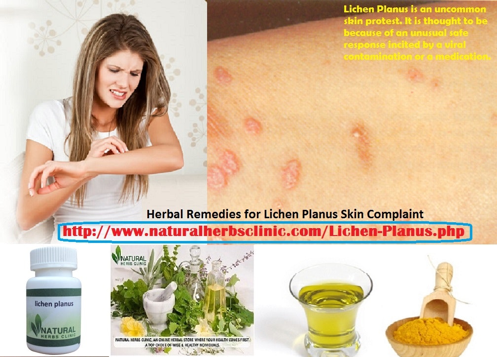 Herbal Remedies for Lichen Planus Skin Complaint