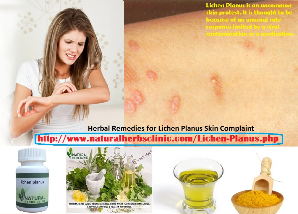 Herbal Remedies for Lichen Planus Skin Complaint