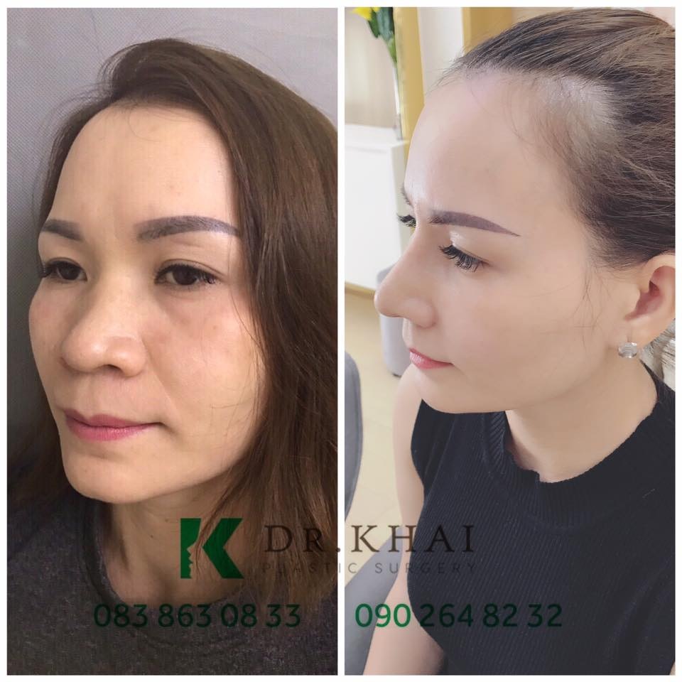 tham my sua mui dep nhat