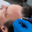 PRP Treatment in Kochi