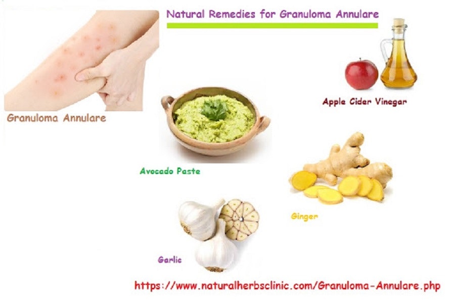 Natural Treatment For Granuloma Annulare Granuloma An vrogue.co