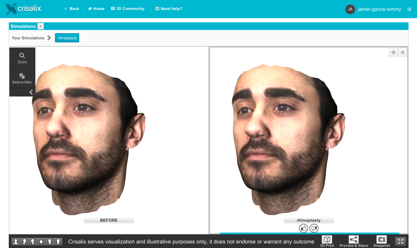 Crisalix gallery image