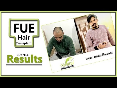 hair transplant gallery image