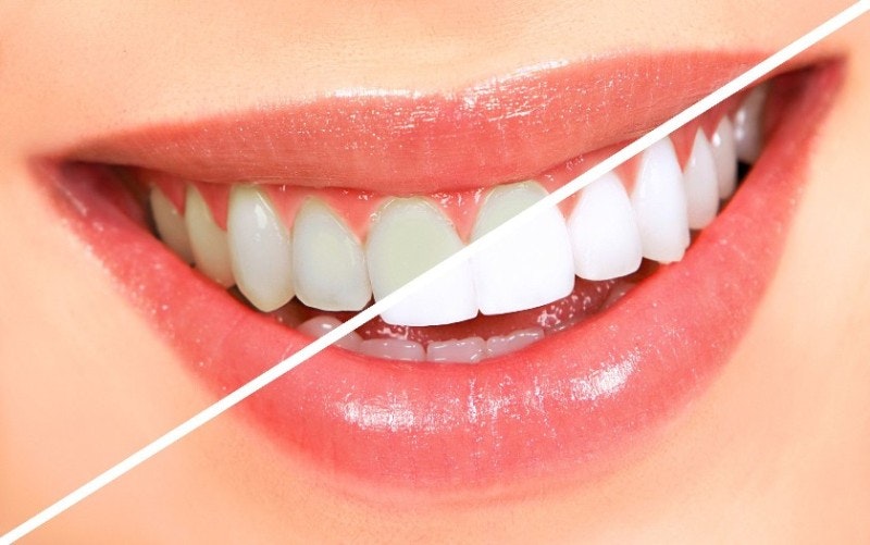 Miglior dentista implantare nel sud di Delhi - miglior dentista implantare nel sud di Delhi media 1