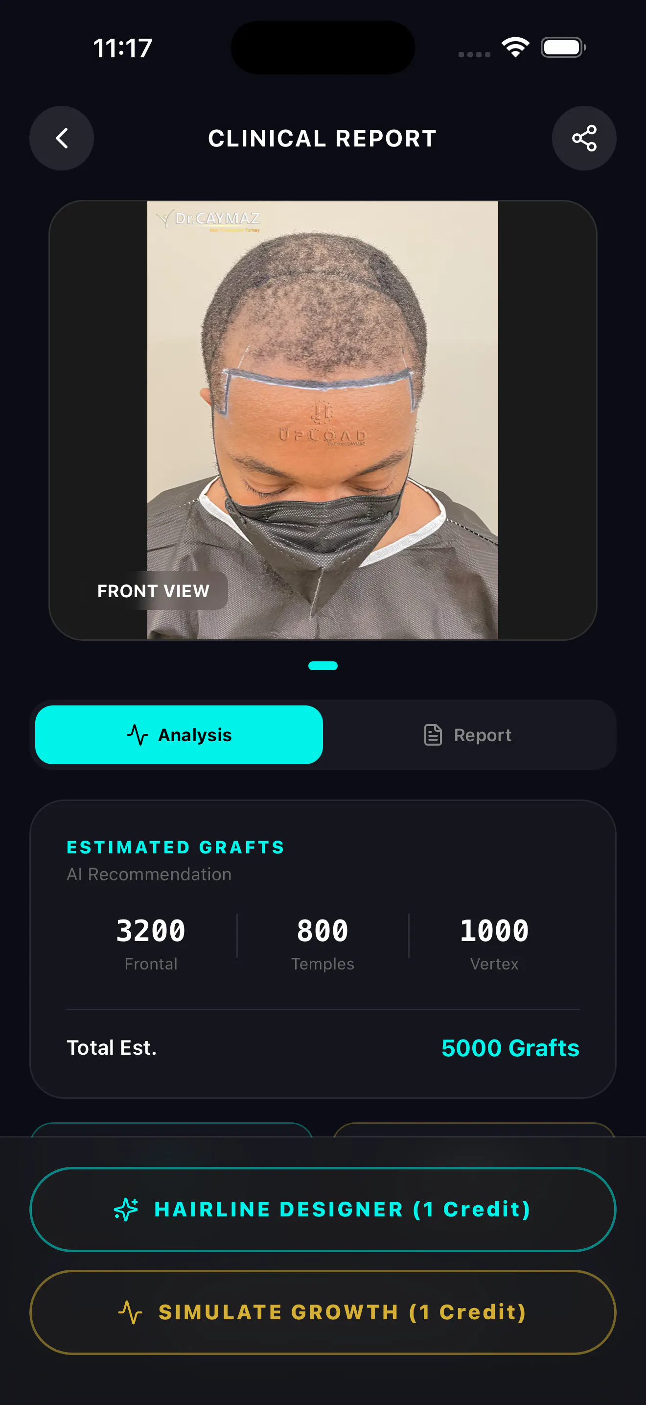 HairArchitect: AI Transplant gallery image