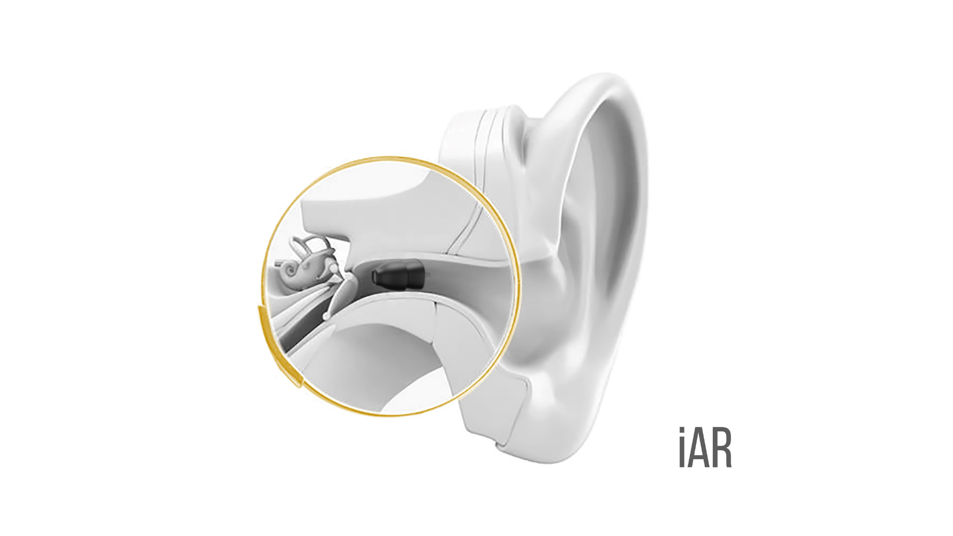 iAR. First 100% Invisible Hearing Aid gallery image