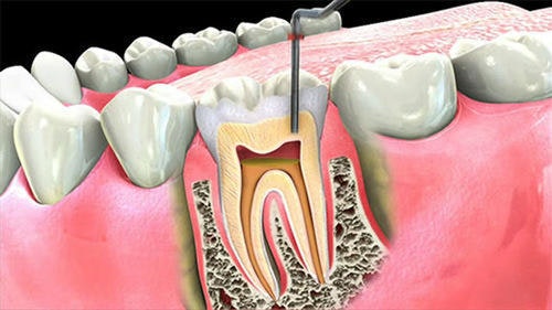 Root canal treatment in Greater Noida