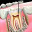 Root canal treatment in Greater Noida