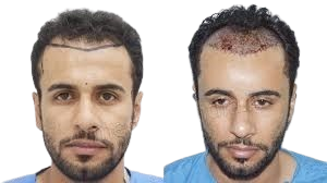 Hair transplantation in Riyadh gallery image