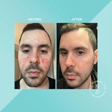Soteri Skin 2-Step Eczema Starter Kit gallery image