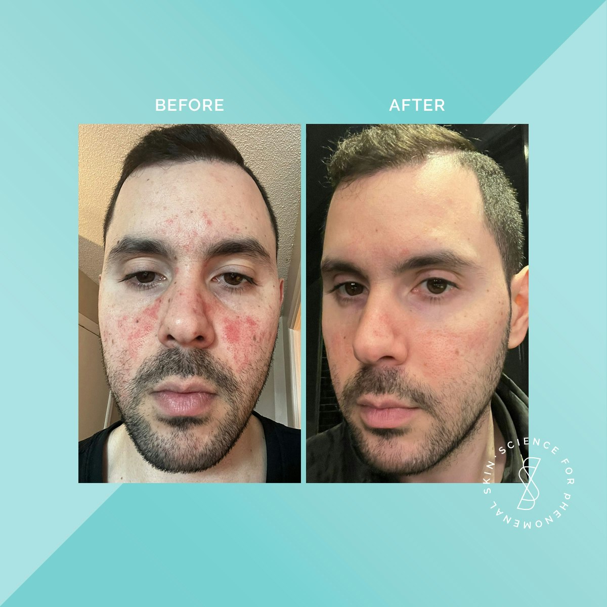 Soteri Skin 2-Step Eczema Starter Kit media 3