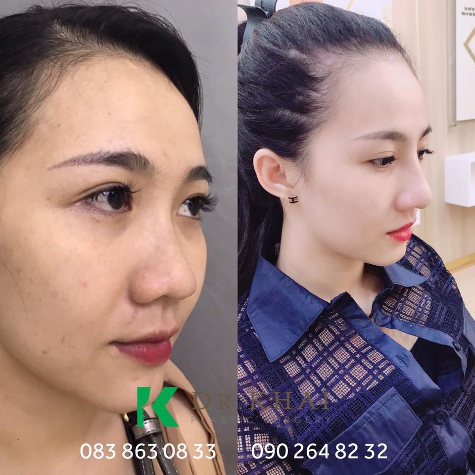 tham my sua mui dep nhat gallery image