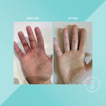 Soteri Skin 2-Step Eczema Starter Kit gallery image