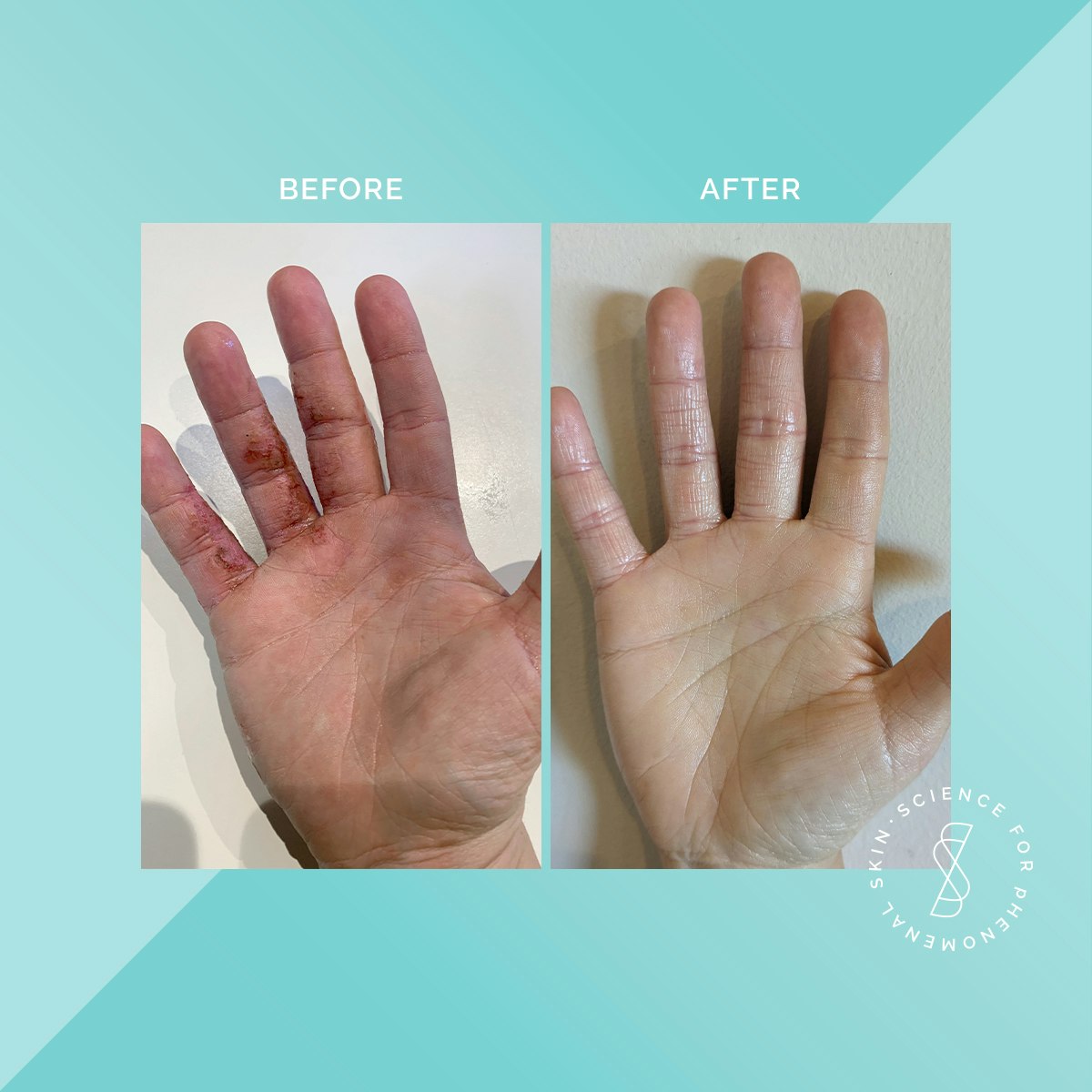Soteri Skin 2-Step Eczema Starter Kit media 4