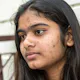 Acne Treatment in Lucknow