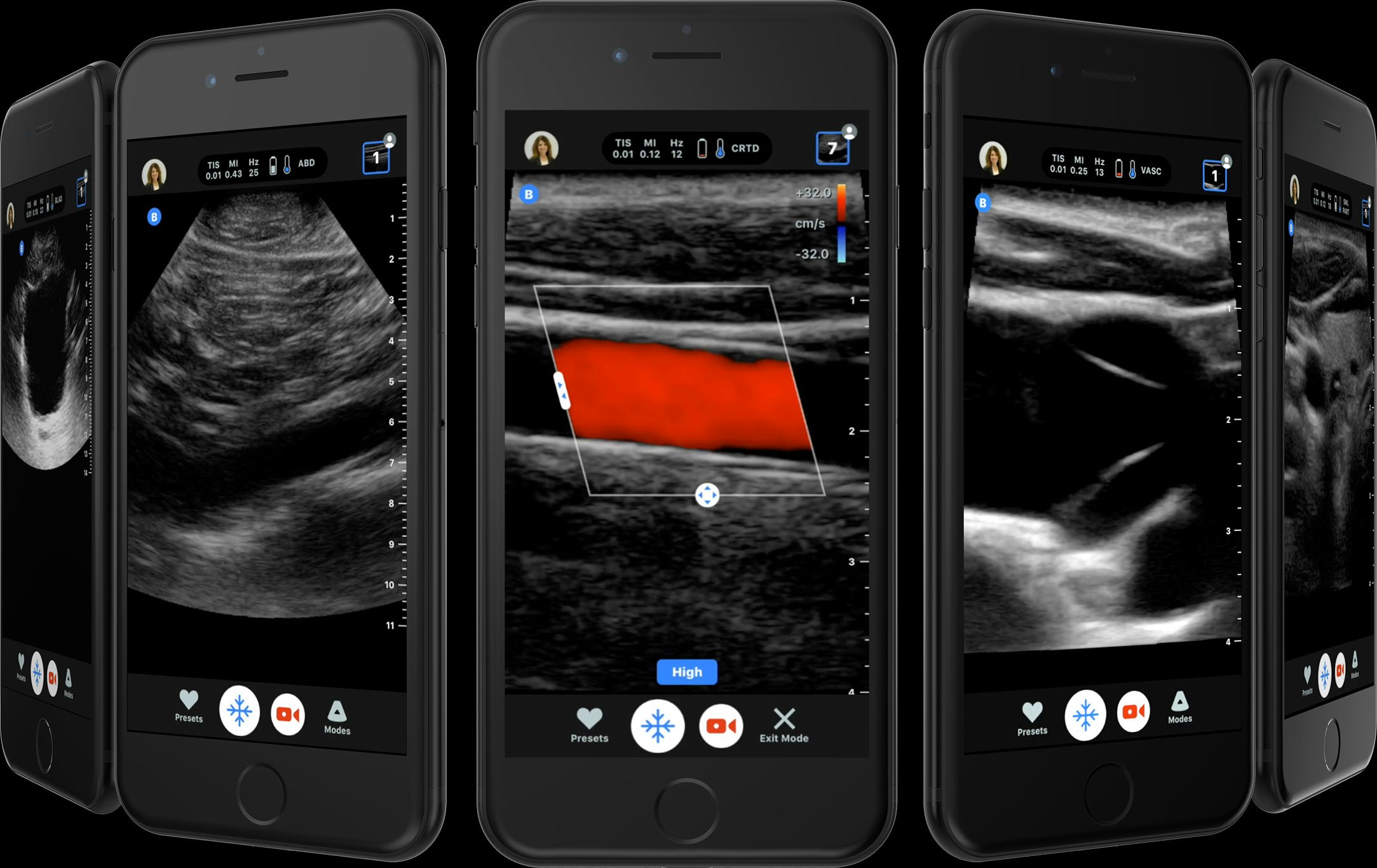 Butterfly iQ gallery image