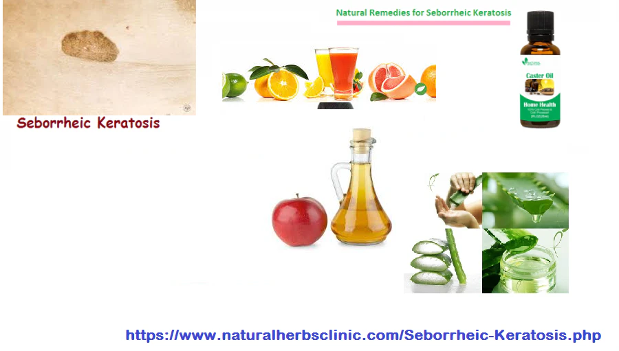 Home Remedies for Seborrheic Keratosis