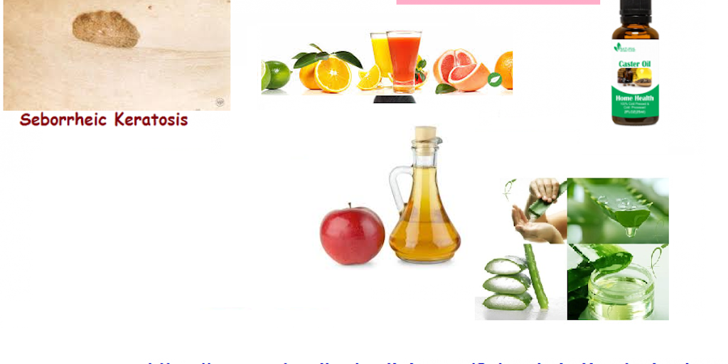Home Remedies for Seborrheic Keratosis Product Information, Latest