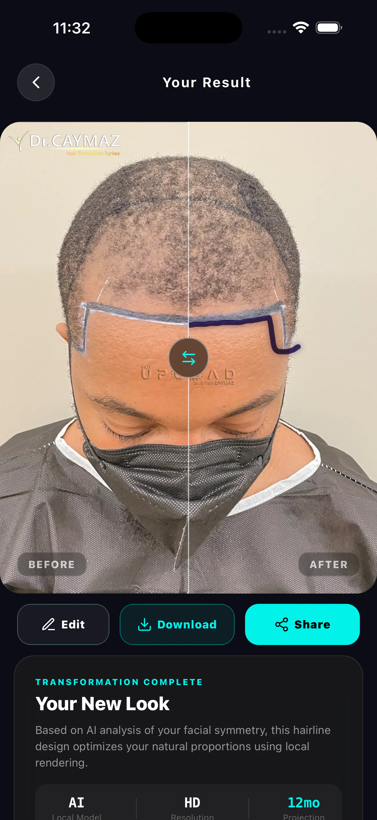 HairArchitect: AI Transplant gallery image