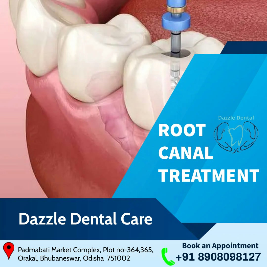  Root canal treatment Sundarpada 