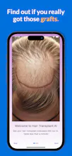 Hair Transplant AI Success gallery image