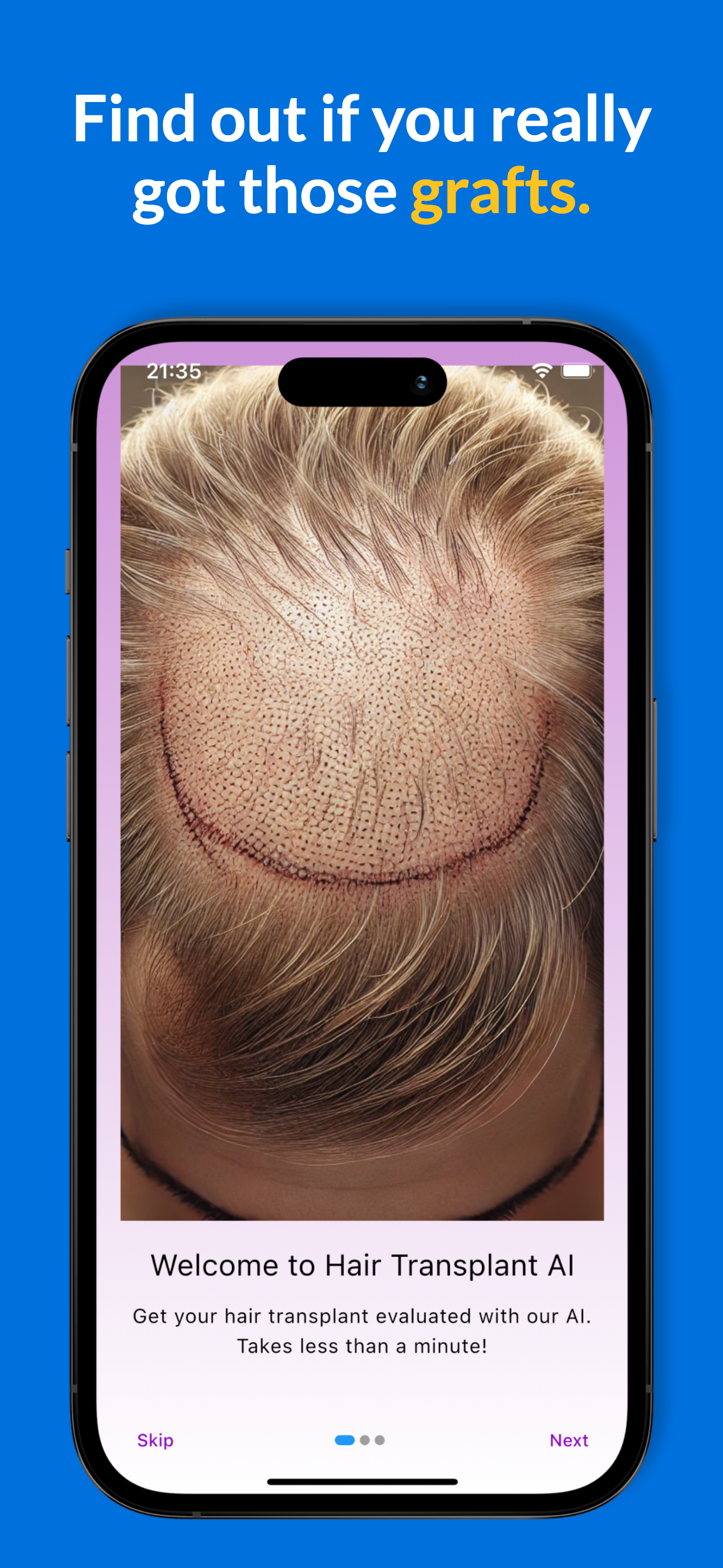 Haartransplantatie AI Succes media 5