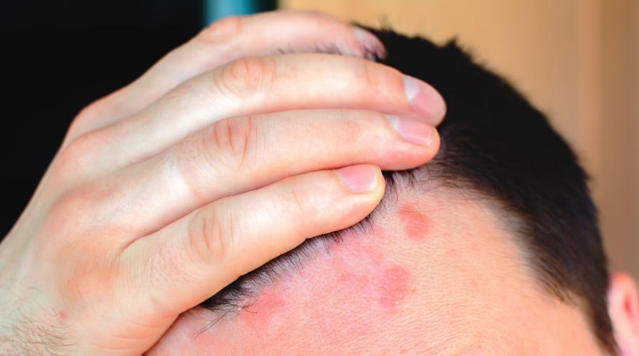 Dandruff treatment in Wakad