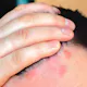 Dandruff treatment in Wakad