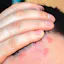 Dandruff treatment in Wakad
