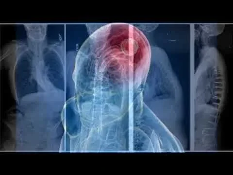 Glioblastoma Cancer San Antonio TX