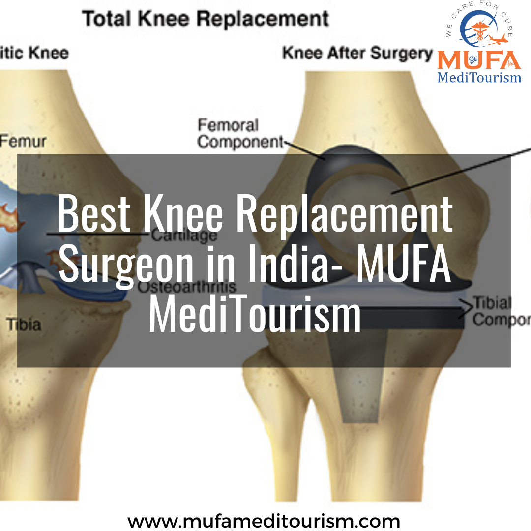Knee Prosthesis