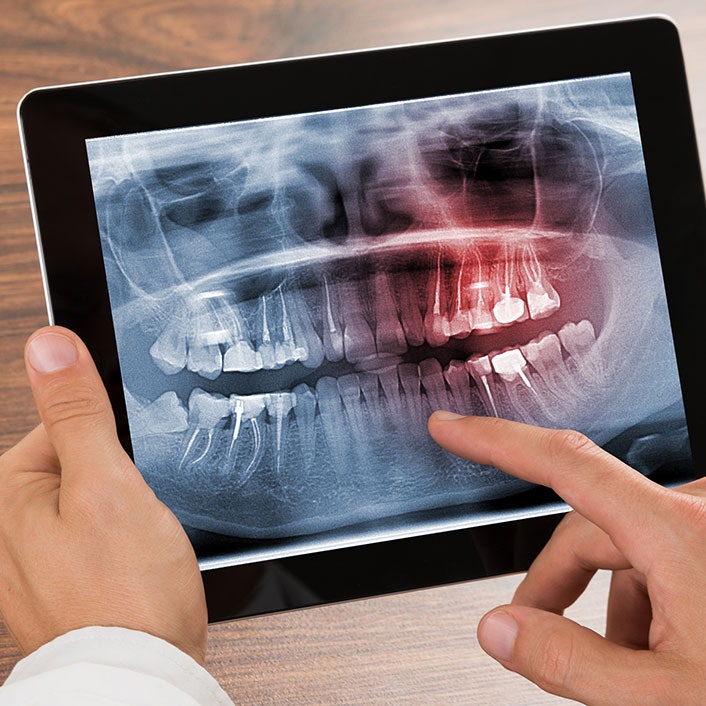 Root canal treatment in Greater Noida gallery image