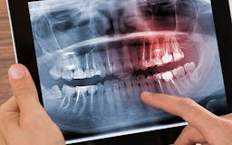 Root canal treatment in Greater Noida media 2